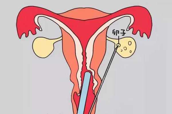 女性卵巢位置高取卵方法解读，要不要经过输卵